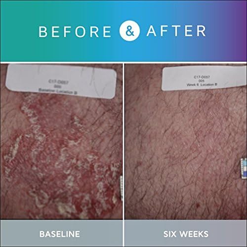 Prosoria Treatment System Single Kit, 2oz