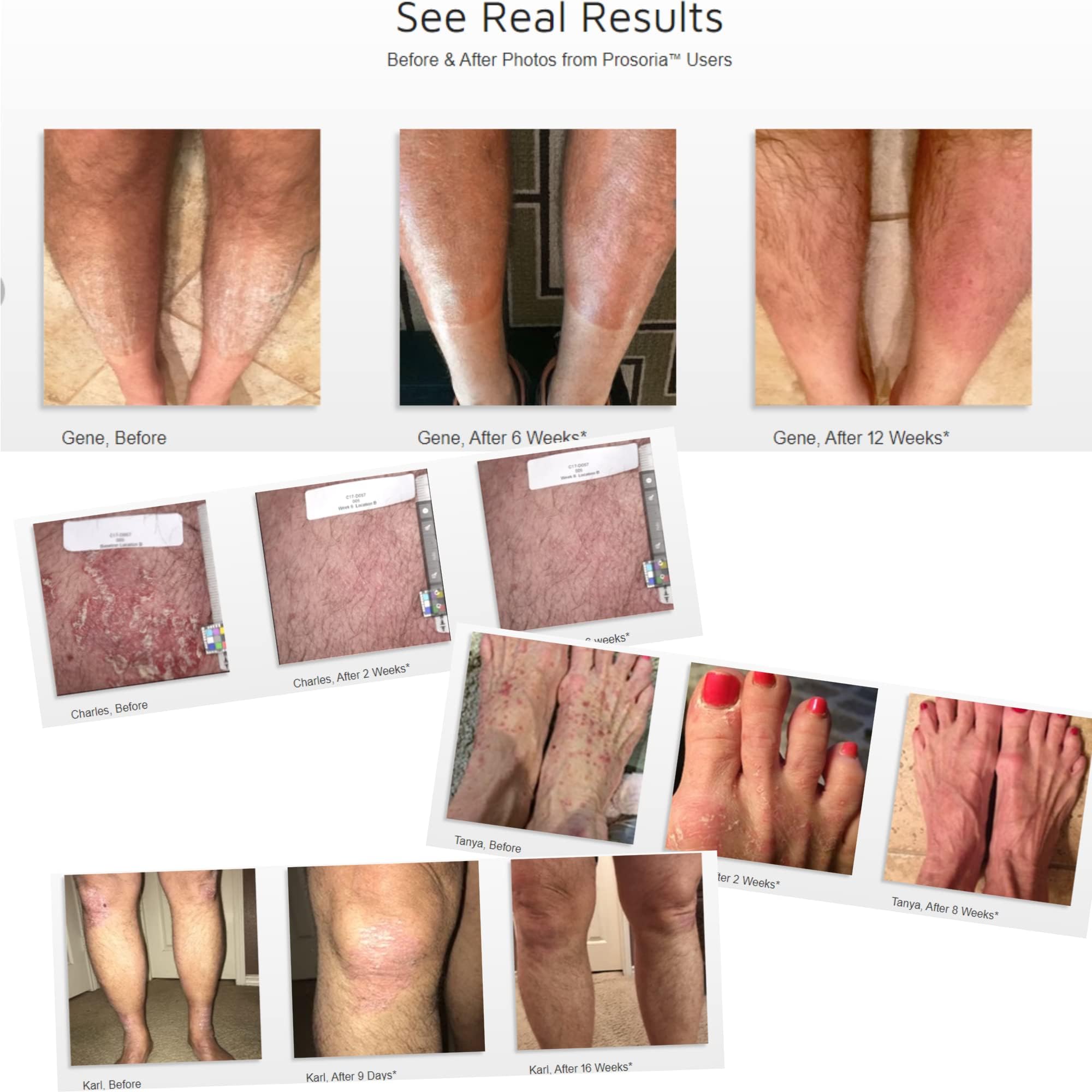 Prosoria Treatment System Single Kit, 2oz